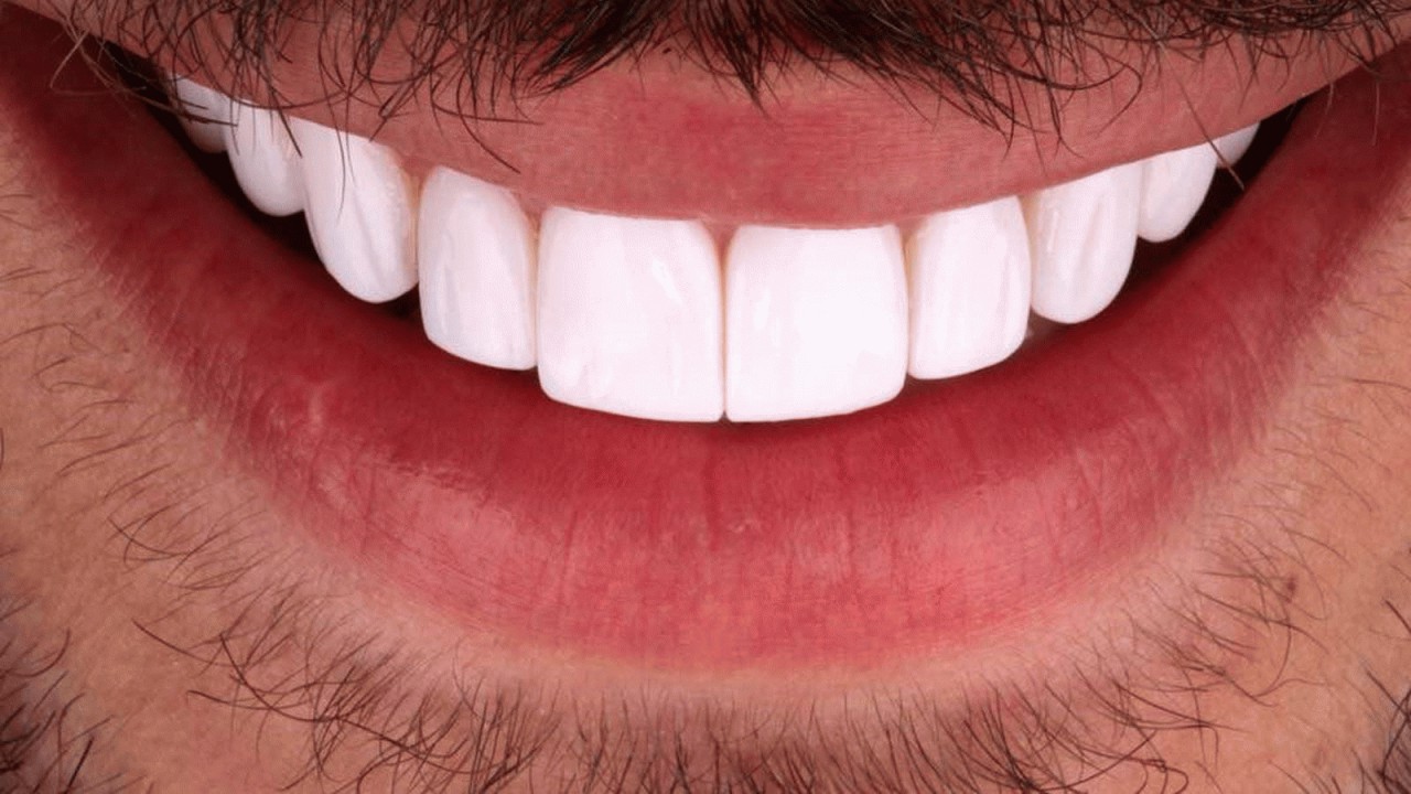 نکات مهمی که باید قبل از لمینت دندان بدانید