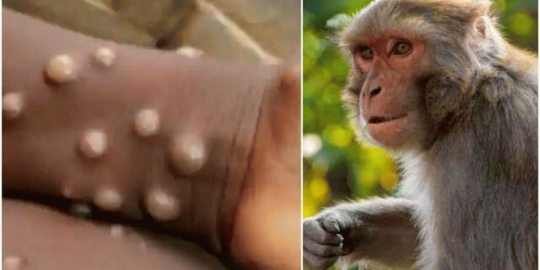 چه کسانی به بیماری آبله میمون مبتلا شده اند؟
